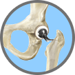 Anterior Approach Hip Replacement