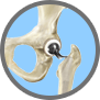 Anterior Approach Hip Replacement