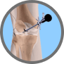 Knee Arthroscopy