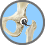 Minimally Invasive Knee Replacement