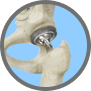 Rapid Recovery and Outpatient Joint Replacement